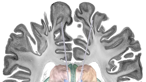 Illustration: Hirnstimulation bei Alzheimer