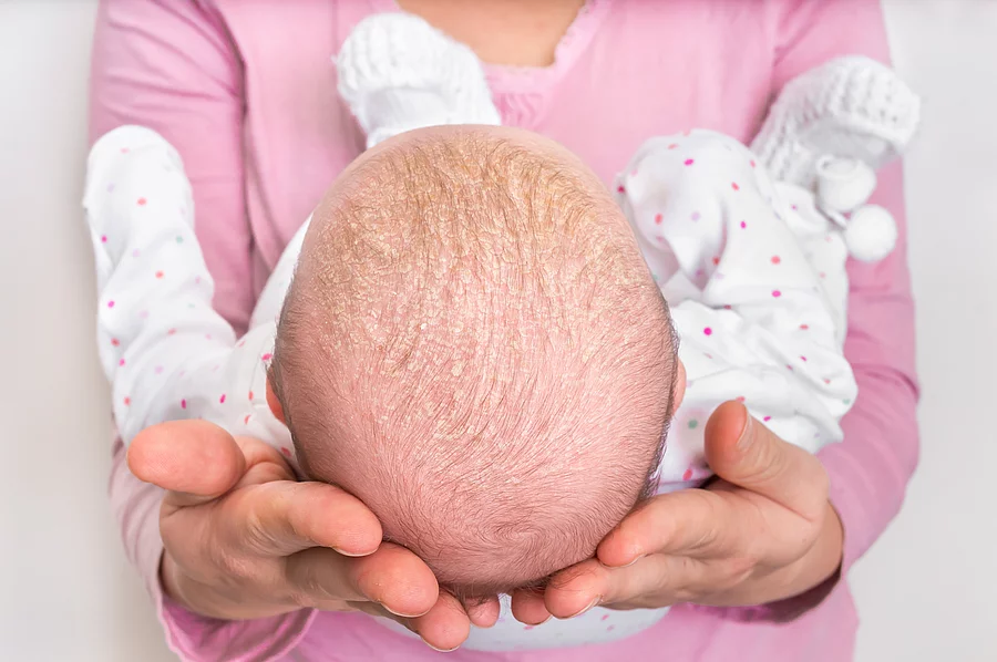 Frau hält ein Baby in ihren Armen, das Schuppenflechte am Kopf hat.
