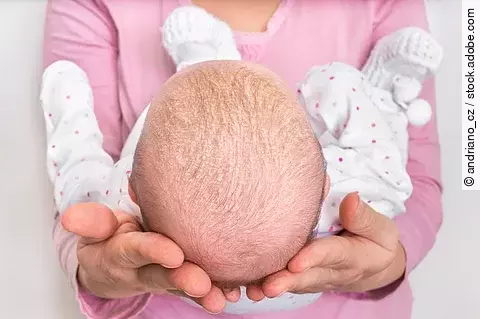 Frau hält ein Baby in ihren Armen, das Schuppenflechte am Kopf hat.