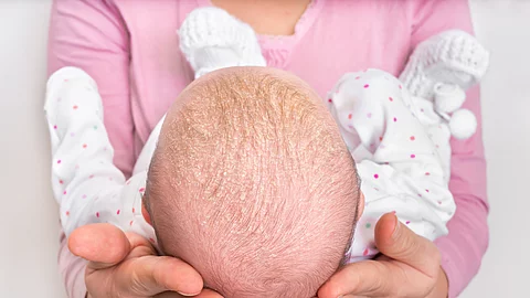 Frau hält ein Baby in ihren Armen, das Schuppenflechte am Kopf hat.