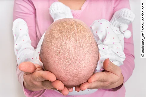 Frau hält ein Baby in ihren Armen, das Schuppenflechte am Kopf hat.