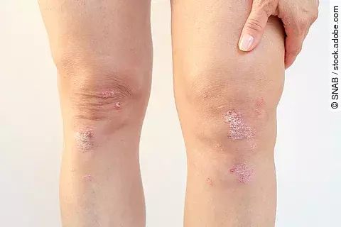 Beine einer Frau mit psoriatischen Veränderungen im Bereich der Knie