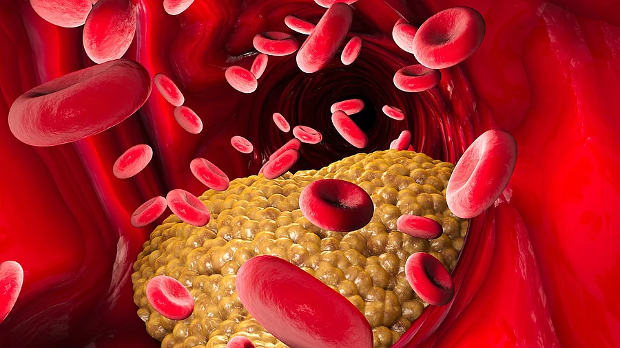 Illustration: Cholesterinablagerung in einem Blutgefäß