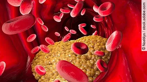Illustration: Cholesterinablagerung in einem Blutgefäß