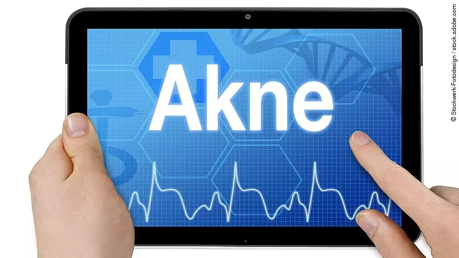 Tablet-Display mit dem Wort Akne auf blauem Screen