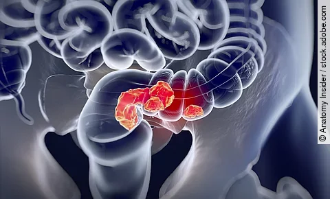 medizinische Illustration: kolorektales Karzinom