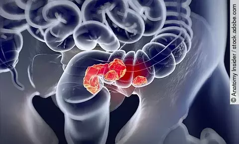 medizinische Illustration: kolorektales Karzinom