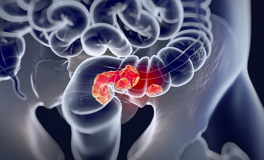 Colorectal cancer,medical illustration.3d illustration medizinische Illustration: kolorektales Karzinom