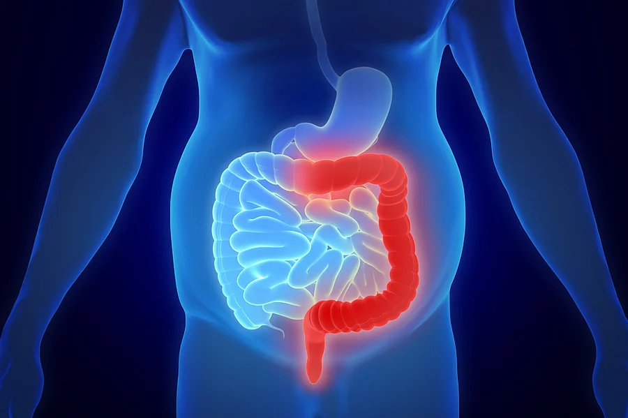 Illustration: Torso mit entzündetem Darm