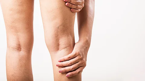   Nahaufnahme Frauenbeine mit Krampfadern, Hinteransicht mit Händen