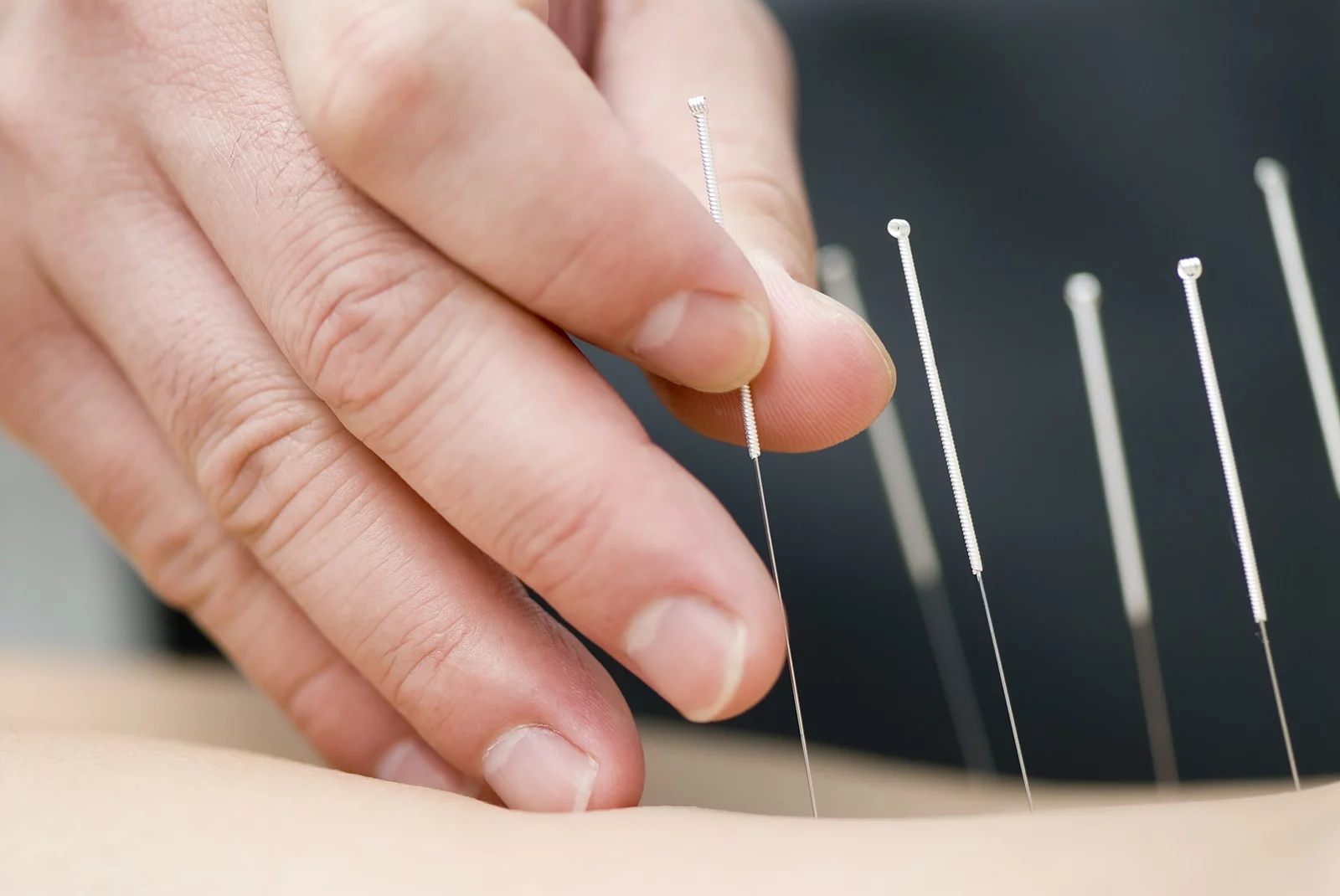 Treatment by acupuncture Hand setzt Akupunkturnadeln am Rücken