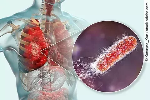Lung infection caused by bacteria Pseudomonas aeruginosa