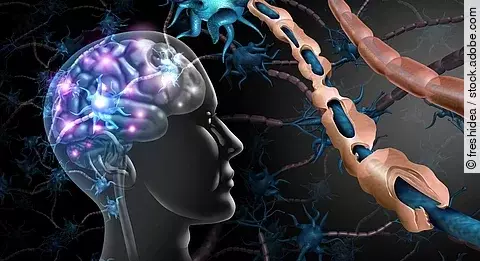 Illustration: zerstörte Myelinscheiden bei Multipler Sklerose, 