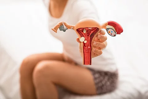 sitzende Frau mit Bauchschmerzen, hält Gebärmuttermodell mit Endometrioseherden