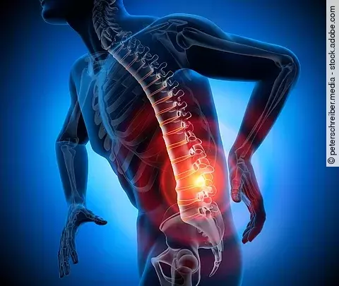 Schematische Darstellung einer schmerzenden Wirbelsäule