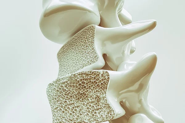 3D-Illustration einer Wirbelsäure bei Osteoporose. 