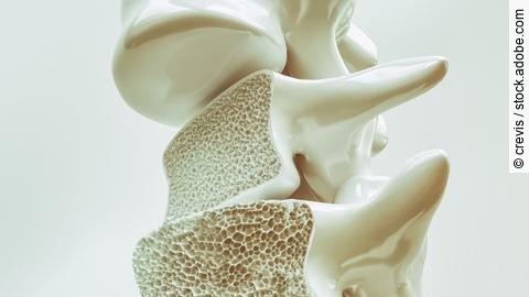 3D-Illustration einer Wirbelsäure bei Osteoporose. 