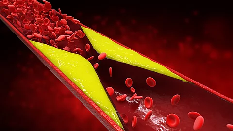 atherosclerosis with plaque in vessel Arteriosklerotische Plaques in einem Blutgefäß