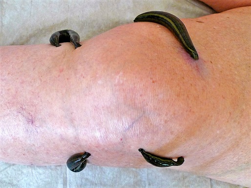 Blutegeltherapie bei Gonarthrose