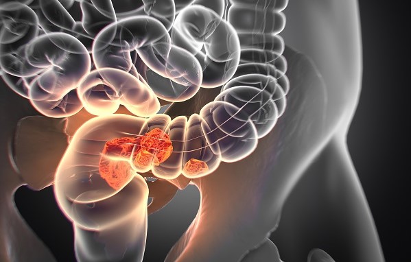 Darmkrebs, medizinische Illustration