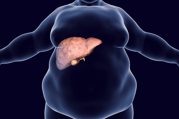 Obese man with fatty liver Illustration: Übergewichtiger Mann mit Fettleber