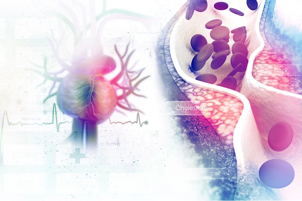 Cholesterol plaque in artery Blutgefäß mit Arteriosklerose, Gefäßverschluss, Illustration